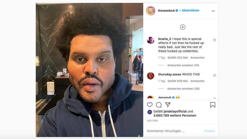 The Weeknd zeigt sich mit Fake-Botox-Gesicht